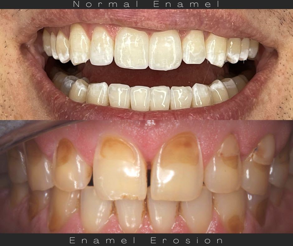 Compare normal Enamel to Eroded Enamel